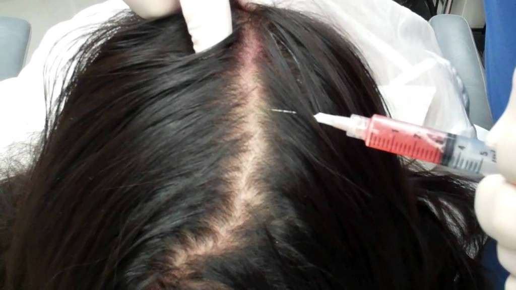 Hair Loss Scarborough Augusta Me Maine Laser Skin Care